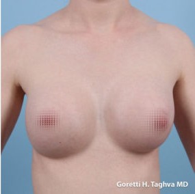 Breast Augmentation before and after - after