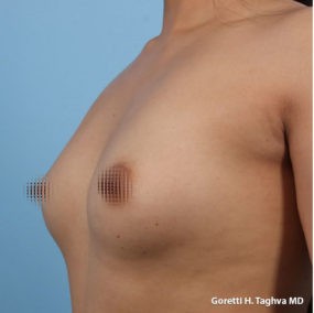 Breast Augmentation before and after - before