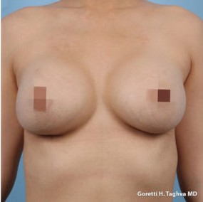 Breast Augmentation before and after - after