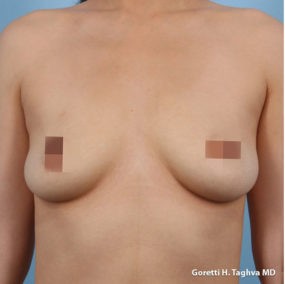 Breast Augmentation before and after - before