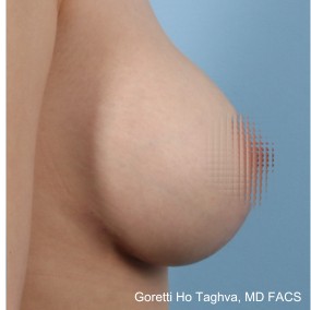 Breast Lift with Augmentation before and after - after