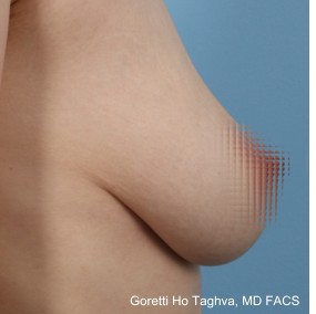 Breast Lift with Augmentation before and after - before