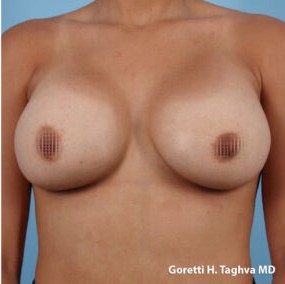 Breast Augmentation before and after - after