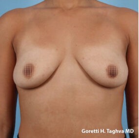 Breast Augmentation before and after - before