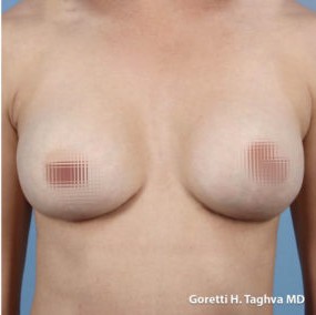 Breast Lift with Augmentation before and after - after
