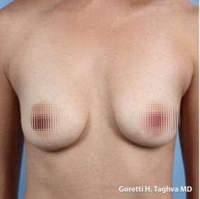 Breast Lift with Augmentation before and after - before