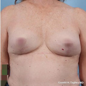 Breast Lift with Augmentation before and after - after