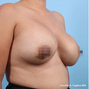 Breast Lift with Augmentation before and after - before