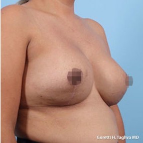 Breast Lift with Augmentation before and after - after