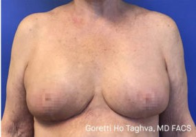 Breast Lift with Augmentation before and after - after