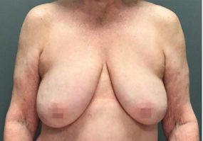 Breast Lift with Augmentation before and after - before