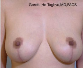 Breast Lift with Augmentation before and after - after