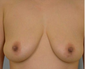Breast Lift with Augmentation before and after - before