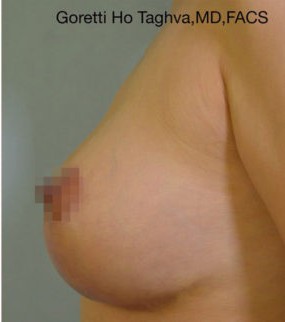 Breast Lift with Augmentation before and after - after