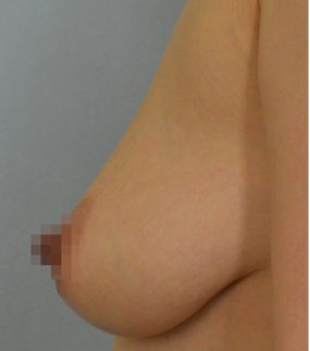 Breast Lift with Augmentation before and after - before