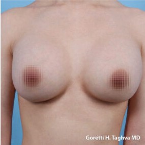 Breast Augmentation before and after - after