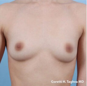 Breast Augmentation before and after - before