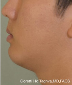 Chin Augmentation after — Dr. Goretti Taghva