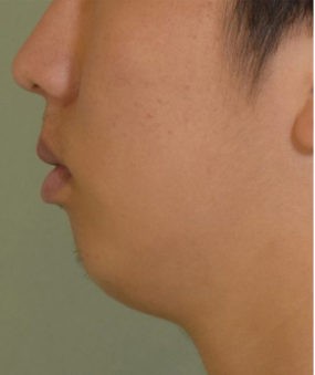 Chin Augmentation before — Dr. Goretti Taghva