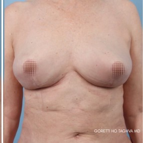 Breast Implant Removal with Capsulectomy, Breast Lift, and Fat Transfer, combined with Liposuction before and after - after