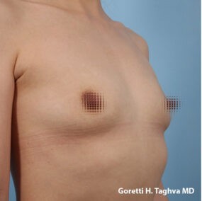 Breast Augmentation before and after - before