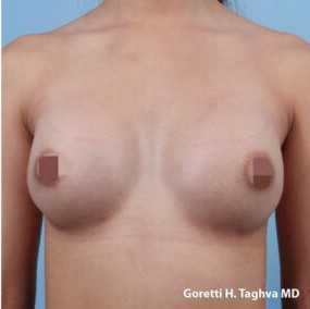 Breast Augmentation before and after - after