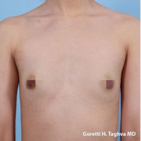 Breast Augmentation before and after - before