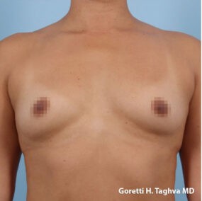 Breast Augmentation before and after - before