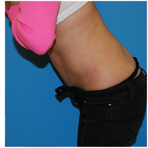 Abdominoplasty before and after - after