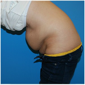 Abdominoplasty before and after - before