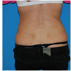 Liposuction before and after - after