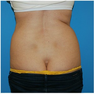 Liposuction before and after - before