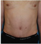 Tummy Tuck / Male Abdominoplasty before and after - after