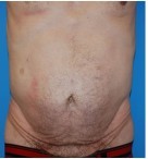 Tummy Tuck / Male Abdominoplasty before and after - before