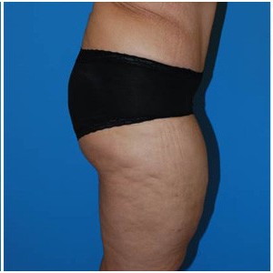 Abdominoplasty before and after - after