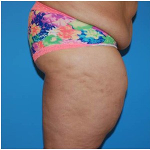 Abdominoplasty before and after - before