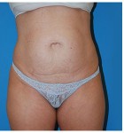 Abdominoplasty before and after - before