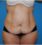 Abdominoplasty before and after - before