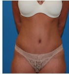 Abdominoplasty before and after - after