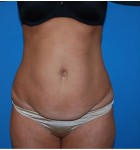 Abdominoplasty before and after - before