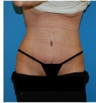 Abdominoplasty before and after - after