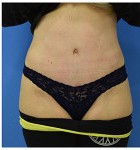 Abdominoplasty before and after - after