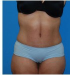 Abdominoplasty before and after - after