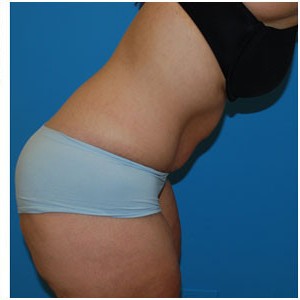 Abdominoplasty before and after - after