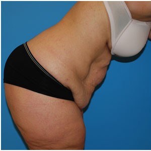 Abdominoplasty before and after - before