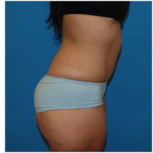 Abdominoplasty before and after - after