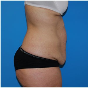 Abdominoplasty before and after - before