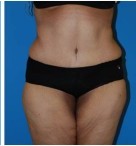 Abdominoplasty before and after - after