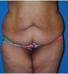 Abdominoplasty before and after - before