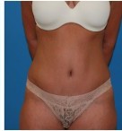 Abdominoplasty before and after - after